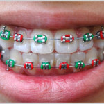 Borrachinhas para Aparelho – Fotos e Modelos