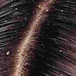 Como se Livrar da Caspa e da Seborréia – Dicas